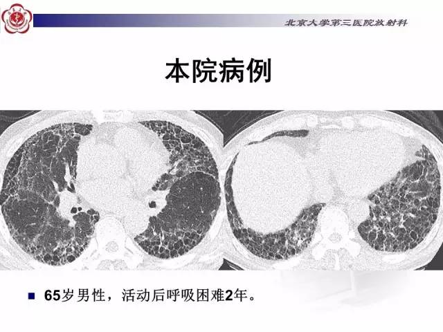 【病例】特发性间质性肺炎2例影像表现