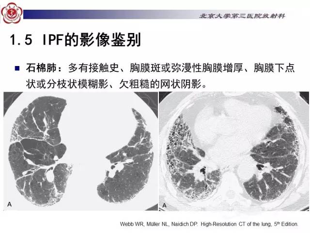 【病例】特发性间质性肺炎2例影像表现