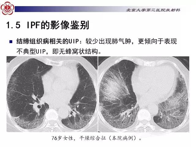 【病例】特发性间质性肺炎2例影像表现