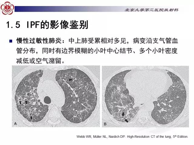 【病例】特发性间质性肺炎2例影像表现