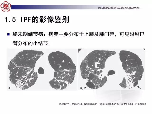 【病例】特发性间质性肺炎2例影像表现