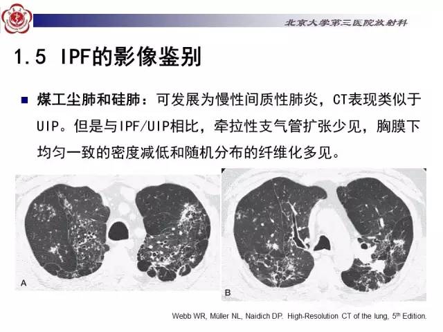 【病例】特发性间质性肺炎2例影像表现