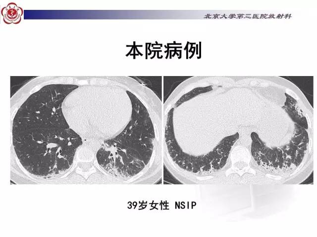【病例】特发性间质性肺炎2例影像表现