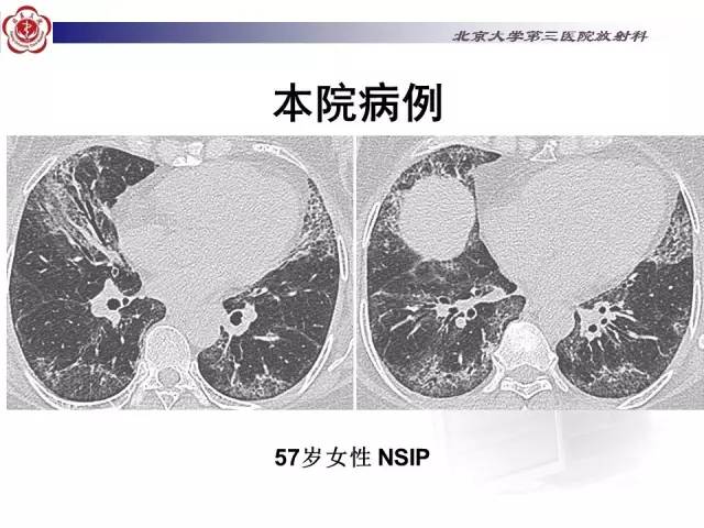 【病例】特发性间质性肺炎2例影像表现