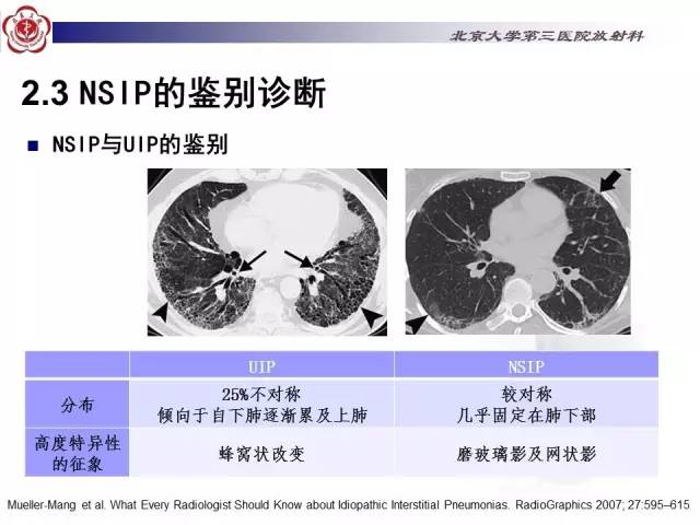 【病例】特发性间质性肺炎2例影像表现