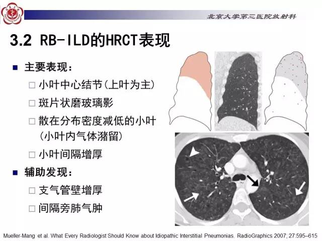 【病例】特发性间质性肺炎2例影像表现