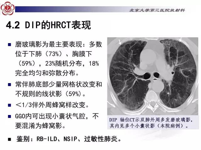 【病例】特发性间质性肺炎2例影像表现