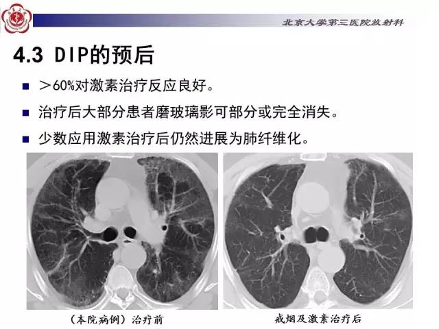 【病例】特发性间质性肺炎2例影像表现
