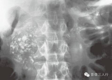 “胰腺钙化”很常见,你知道见于哪些疾病吗? “胰腺钙化”很常见,你知道见于哪些疾病吗?