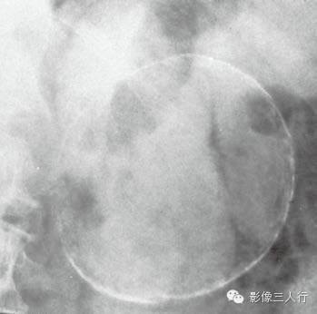 “胰腺钙化”很常见，你知道见于哪些疾病吗？