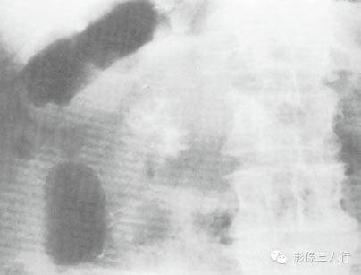 “胰腺钙化”很常见,你知道见于哪些疾病吗? “胰腺钙化”很常见,你知道见于哪些疾病吗?