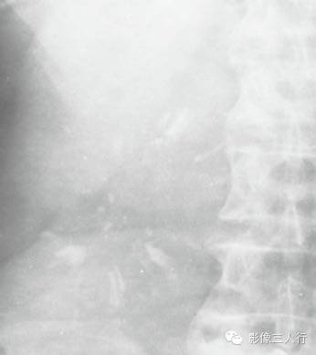 “胰腺钙化”很常见,你知道见于哪些疾病吗? “胰腺钙化”很常见,你知道见于哪些疾病吗?