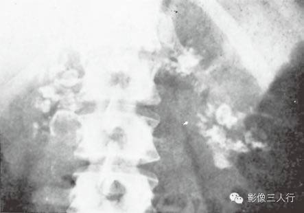 “胰腺钙化”很常见,你知道见于哪些疾病吗? “胰腺钙化”很常见,你知道见于哪些疾病吗?