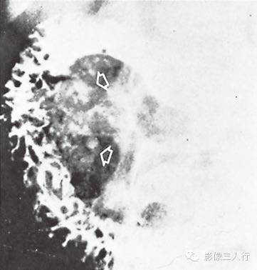 “胰腺钙化”很常见,你知道见于哪些疾病吗? “胰腺钙化”很常见,你知道见于哪些疾病吗?