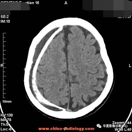 常见的疾病,少听的名字——盔甲脑 常见的疾病,少听的名字——盔甲脑