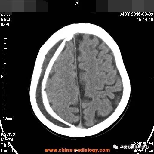 常见的疾病,少听的名字——盔甲脑 常见的疾病,少听的名字——盔甲脑