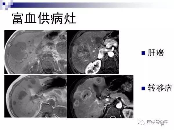 【PPT】肝占位病变影像诊断思路