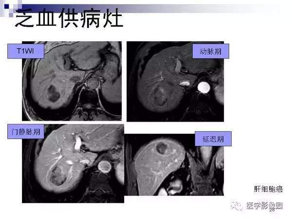 【PPT】肝占位病变影像诊断思路
