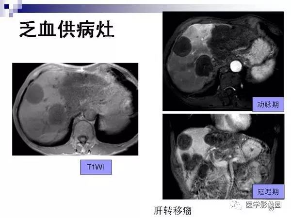 【PPT】肝占位病变影像诊断思路
