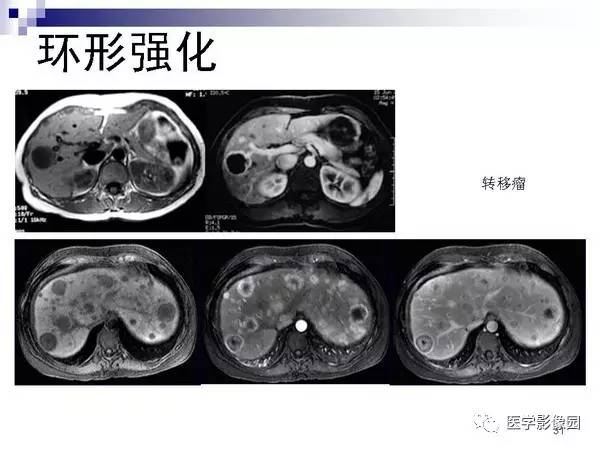 【PPT】肝占位病变影像诊断思路