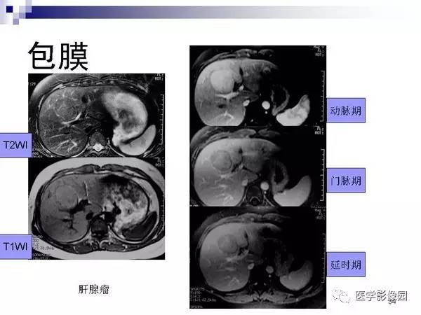【PPT】肝占位病变影像诊断思路