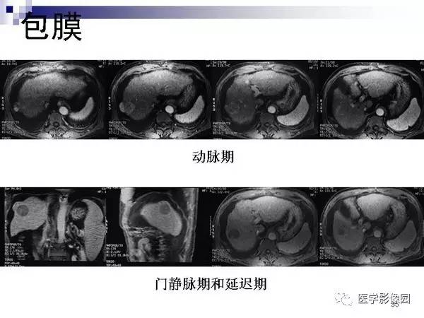 【PPT】肝占位病变影像诊断思路