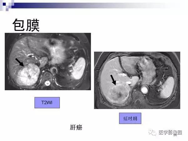 【PPT】肝占位病变影像诊断思路