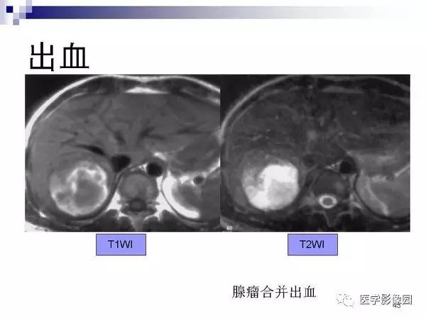 【PPT】肝占位病变影像诊断思路