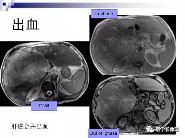 【PPT】肝占位病变影像诊断思路