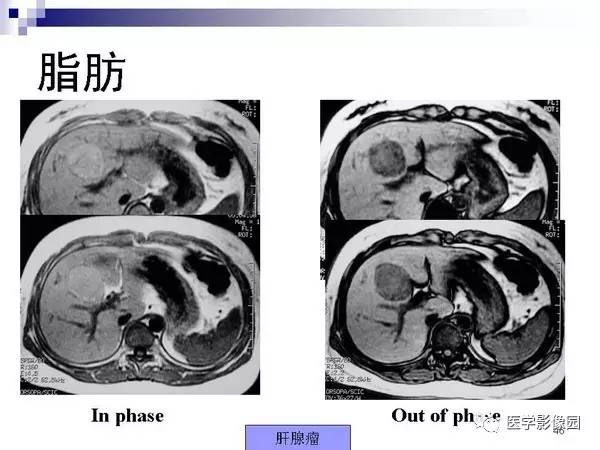 【PPT】肝占位病变影像诊断思路