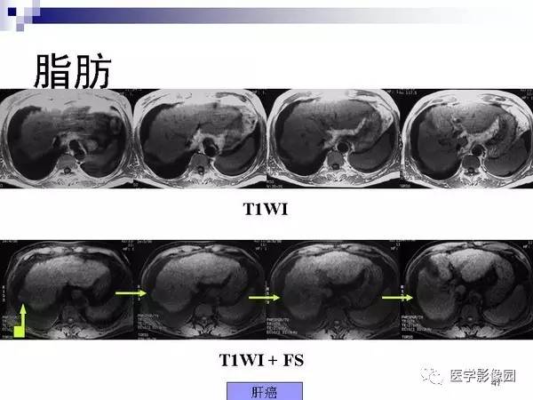 【PPT】肝占位病变影像诊断思路