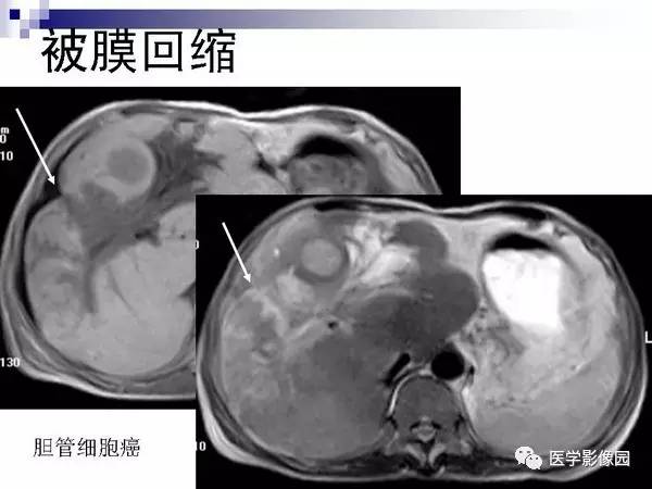 【PPT】肝占位病变影像诊断思路