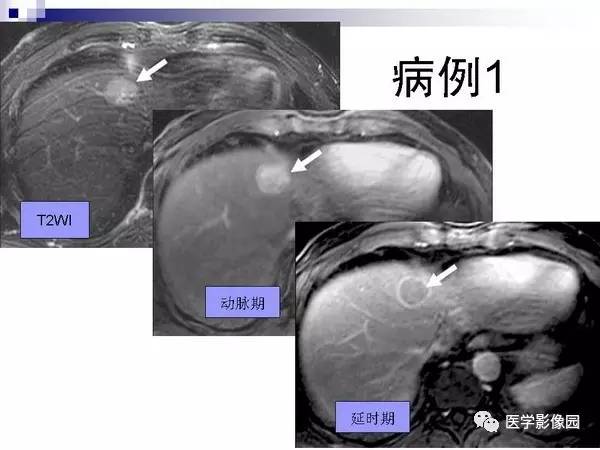 【PPT】肝占位病变影像诊断思路