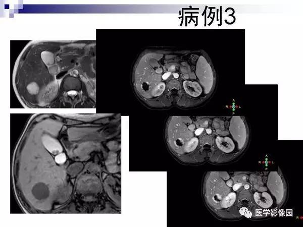 【PPT】肝占位病变影像诊断思路