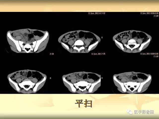 【病例】小肠壁异位胰腺1例CT