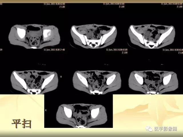 【病例】小肠壁异位胰腺1例CT