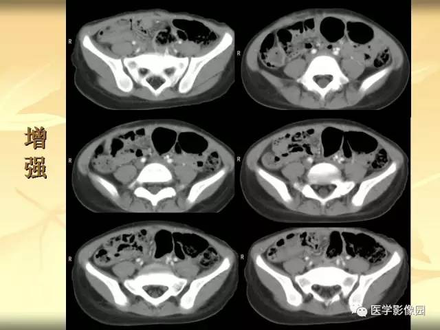 【病例】小肠壁异位胰腺1例CT