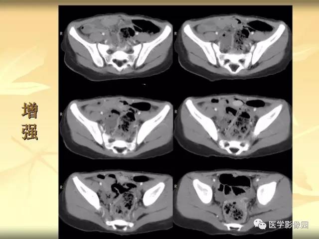 【病例】小肠壁异位胰腺1例CT