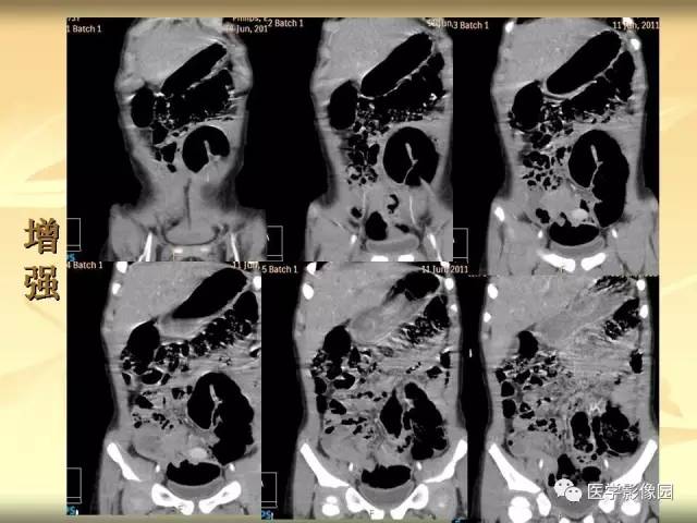 【病例】小肠壁异位胰腺1例CT