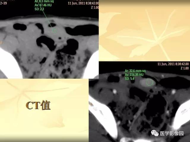 【病例】小肠壁异位胰腺1例CT
