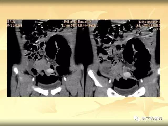 【病例】小肠壁异位胰腺1例CT