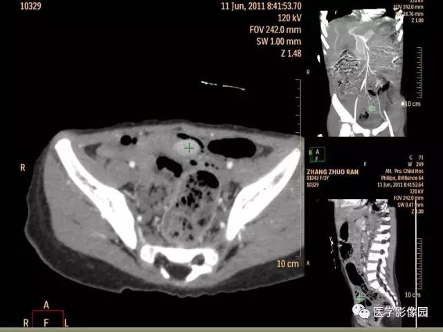 【病例】小肠壁异位胰腺1例CT