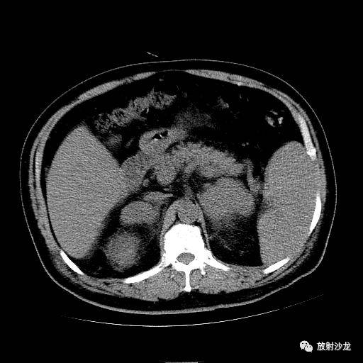 【病例】肾上腺淋巴瘤1例影像解析