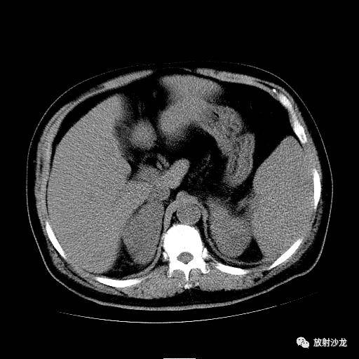 【病例】肾上腺淋巴瘤1例影像解析