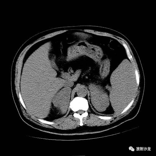 【病例】肾上腺淋巴瘤1例影像解析