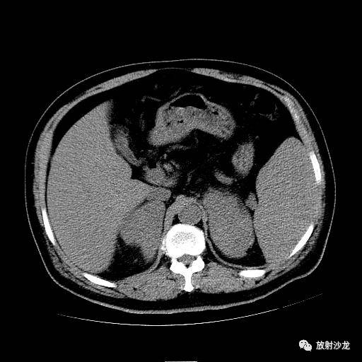 【病例】肾上腺淋巴瘤1例影像解析