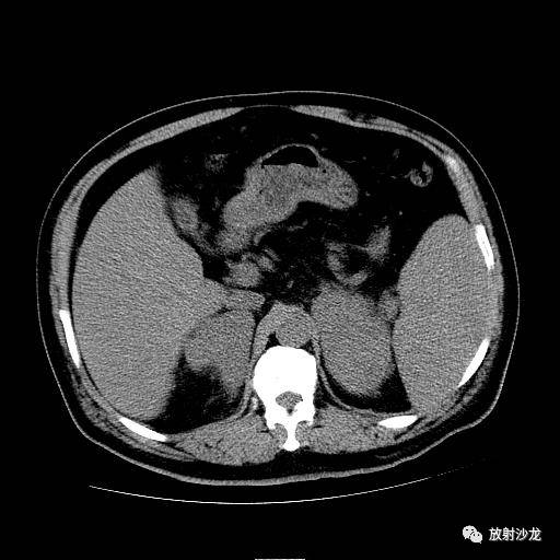 【病例】肾上腺淋巴瘤1例影像解析