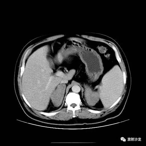 【病例】肾上腺淋巴瘤1例影像解析