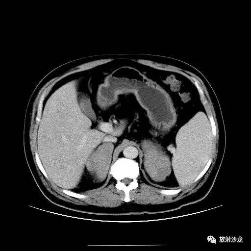 【病例】肾上腺淋巴瘤1例影像解析