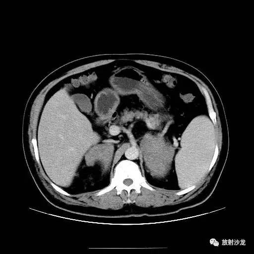 【病例】肾上腺淋巴瘤1例影像解析